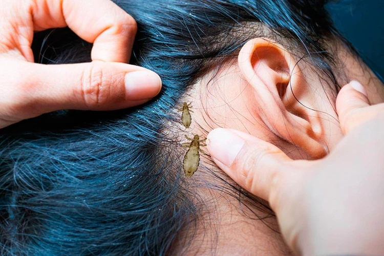 Traumdeutung Von Läusen In Den Haaren